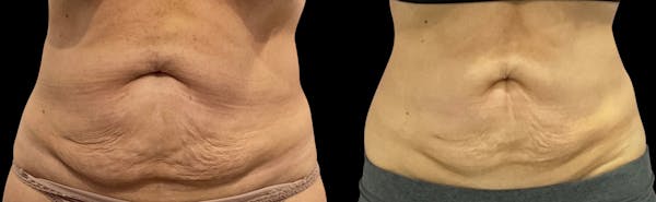 Skin Tightening Before & After Gallery - Patient 427641 - Image 1
