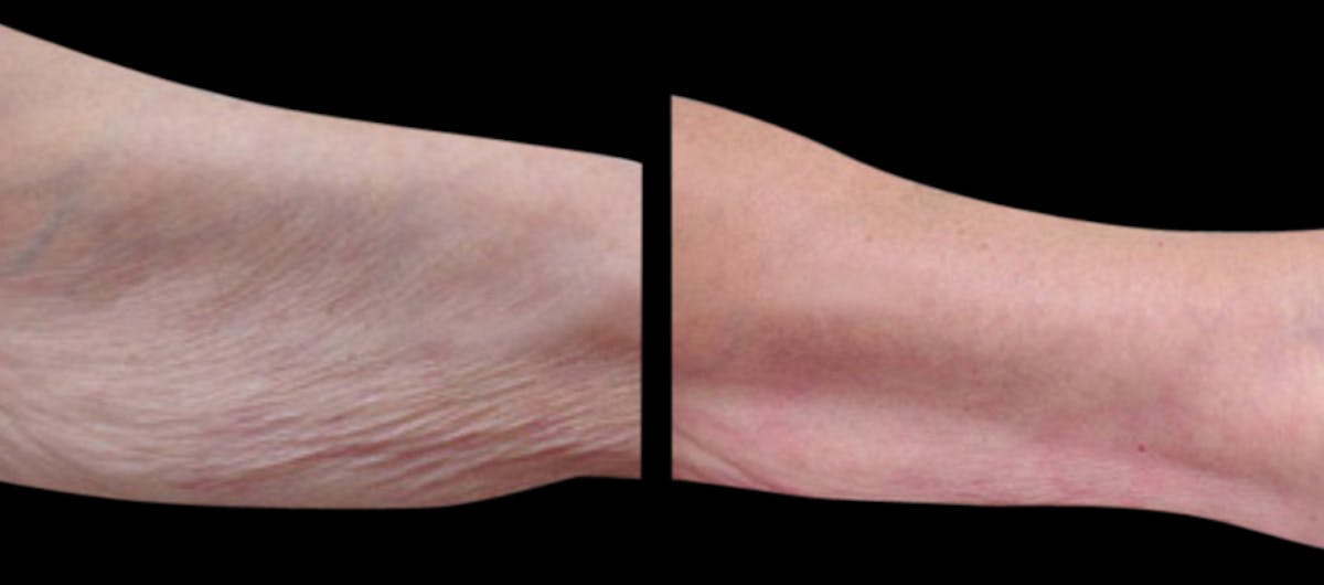 Skin Tightening Before & After Gallery - Patient 351255 - Image 1