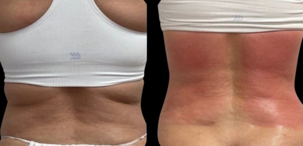 Skin Tightening Before & After Gallery - Patient 256412 - Image 1