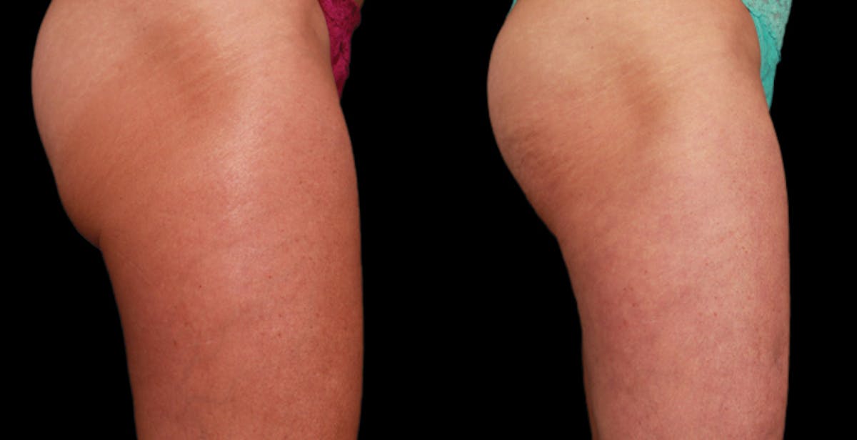 Skin Tightening Before & After Gallery - Patient 723613 - Image 1