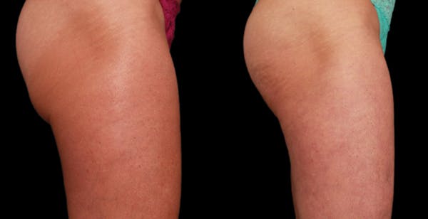 Skin Tightening Before & After Gallery - Patient 723613 - Image 1