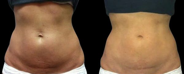 Skin Tightening Before & After Gallery - Patient 415519 - Image 1