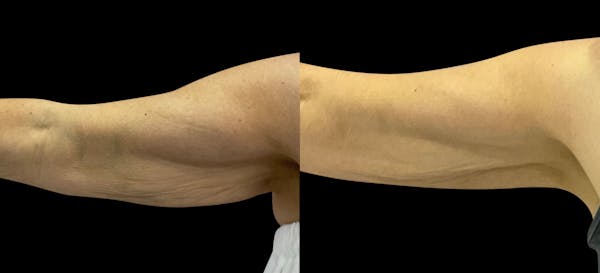 Skin Tightening Before & After Gallery - Patient 385342 - Image 1