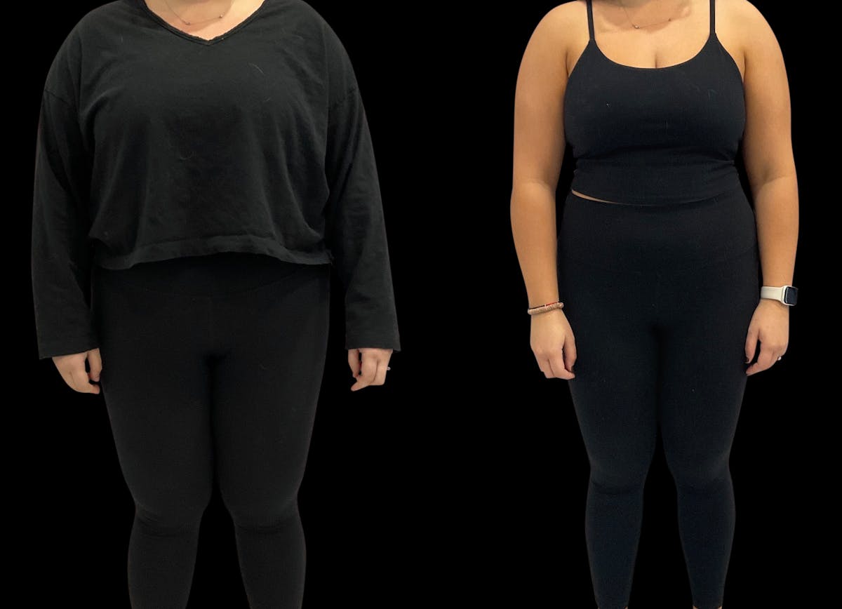 Weight Loss Before & After Gallery - Patient 189389 - Image 2