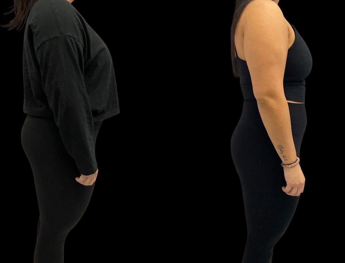 Weight Loss Before & After Gallery - Patient 189389 - Image 3