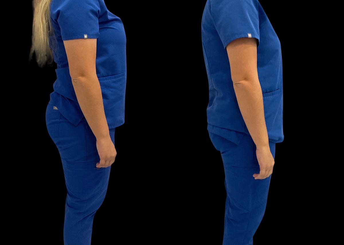 Weight Loss Before & After Gallery - Patient 210686 - Image 3