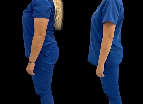 Weight Loss Before & After Gallery - Patient 210686 - Image 1