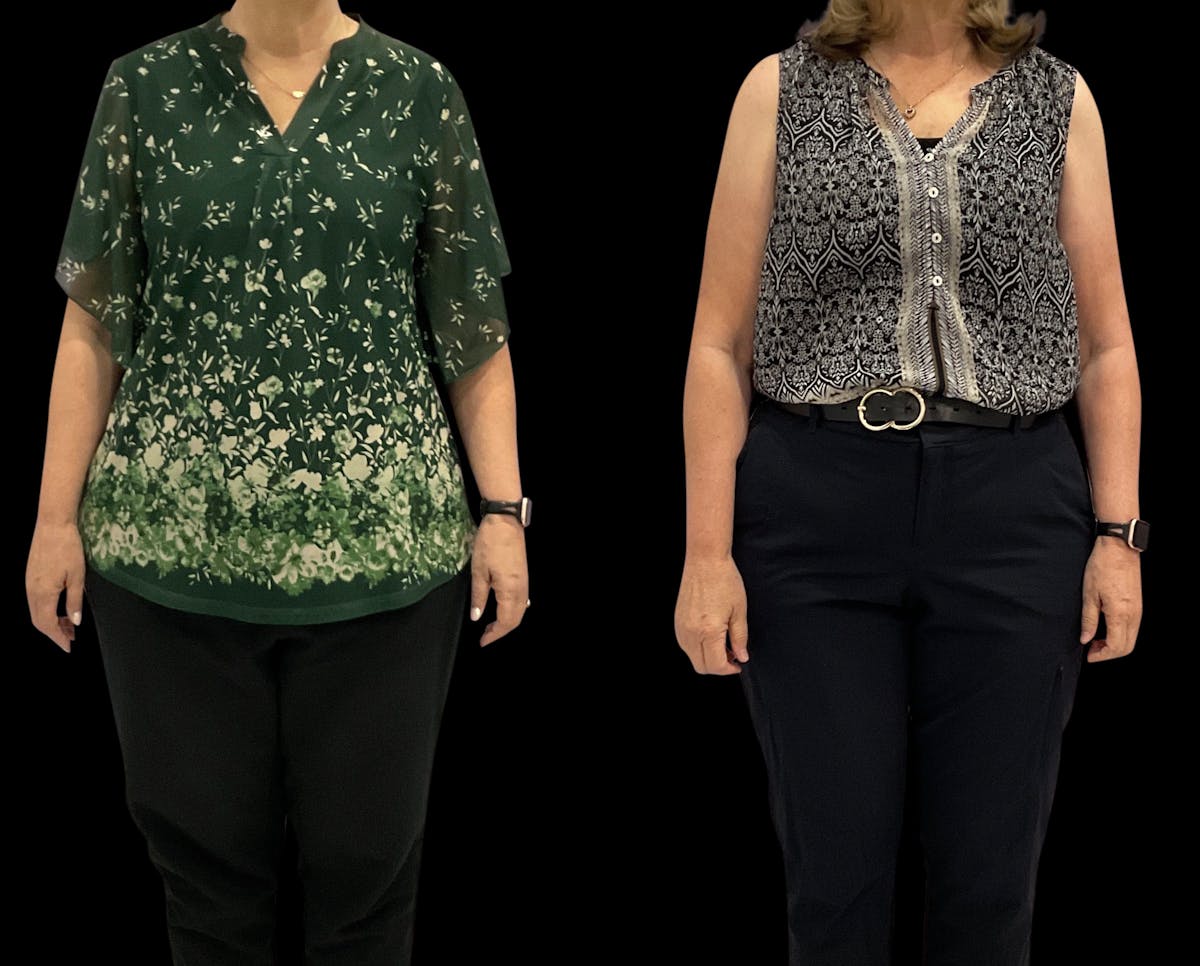 Weight Loss Before & After Gallery - Patient 921055 - Image 2
