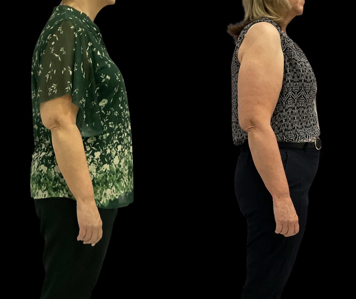 Weight Loss Before & After Gallery - Patient 921055 - Image 3