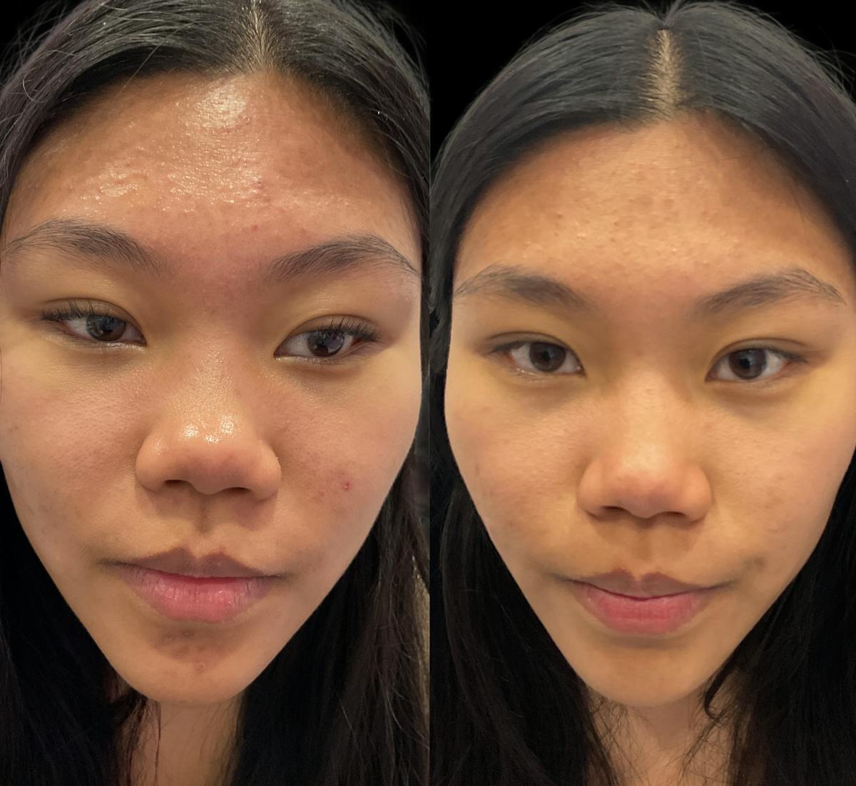 Acne Facial Before & After Gallery - Patient 239323 - Image 2
