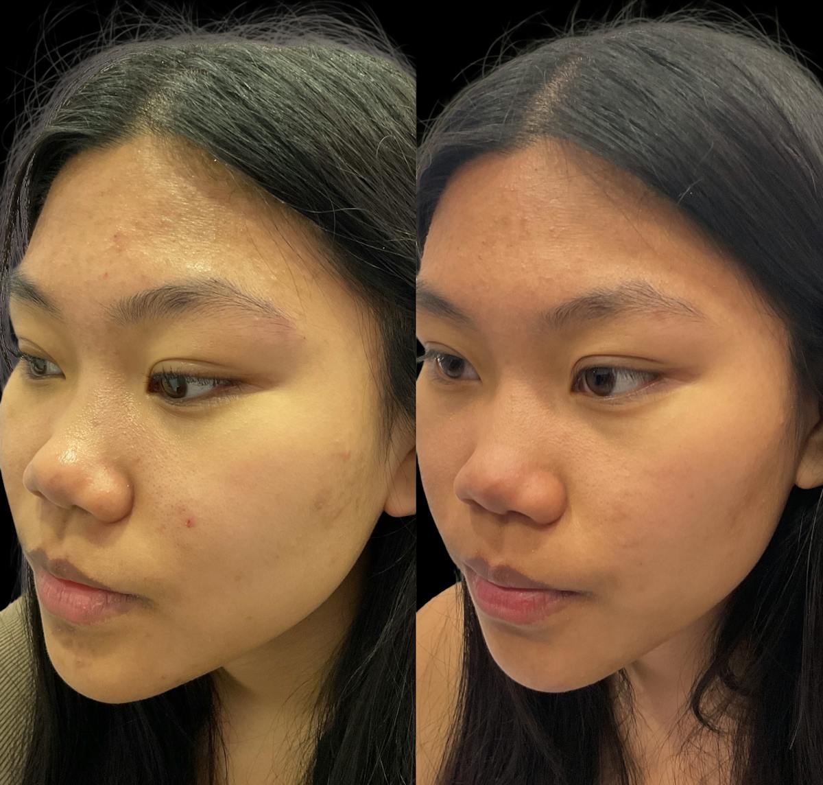 Acne Facial Before & After Gallery - Patient 239323 - Image 1