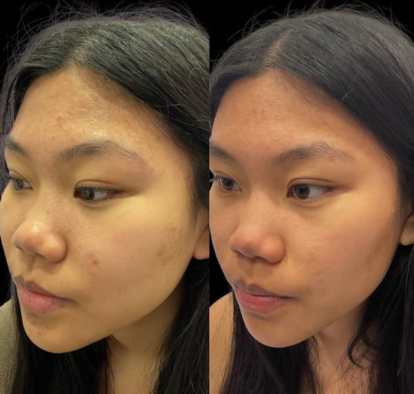 Acne Facial Before & After Gallery - Patient 239323 - Image 1
