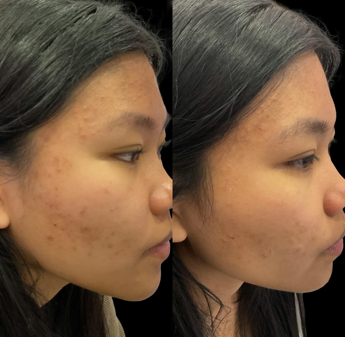 Acne Facial Before & After Gallery - Patient 239323 - Image 3