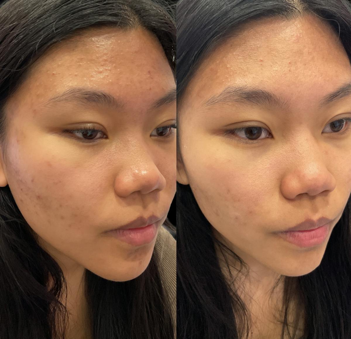 Acne Facial Before & After Gallery - Patient 239323 - Image 4