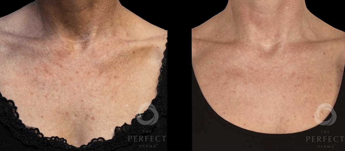 Chemical Peels Before & After Gallery - Patient 228029 - Image 1