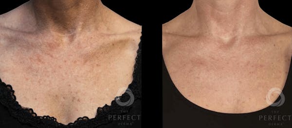 Chemical Peels Before & After Gallery - Patient 228029 - Image 1