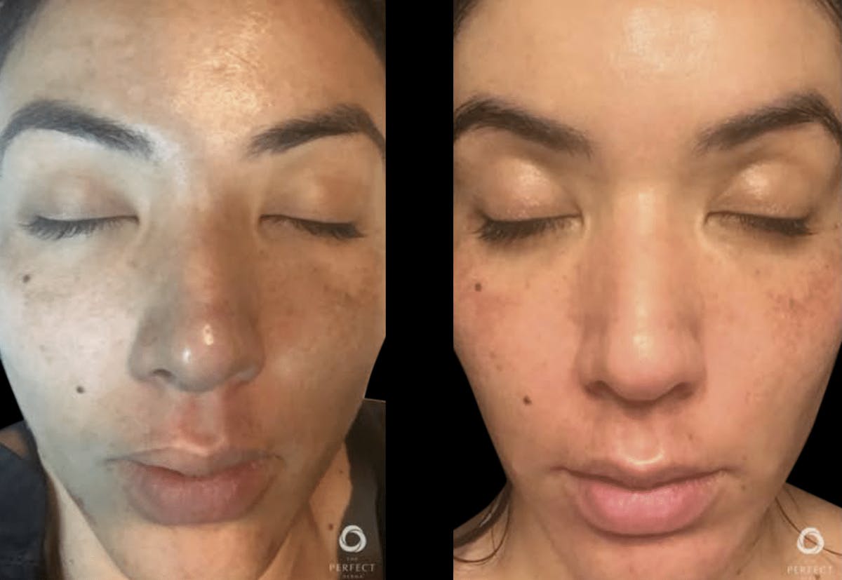 Chemical Peels Before & After Gallery - Patient 187224 - Image 1