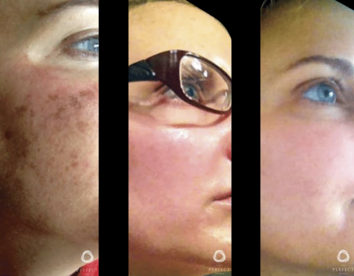 Chemical Peels Before & After Gallery - Patient 199144 - Image 1