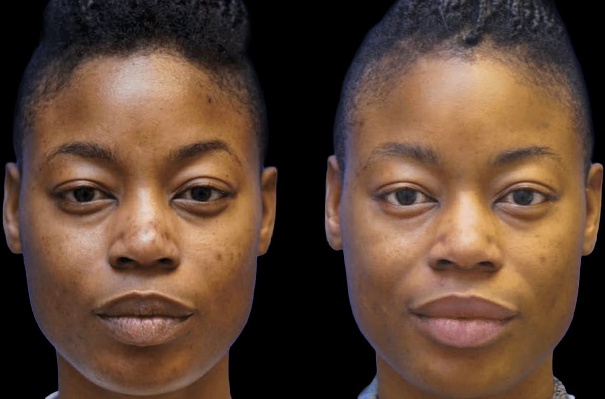 Chemical Peels Before & After Gallery - Patient 119034 - Image 1
