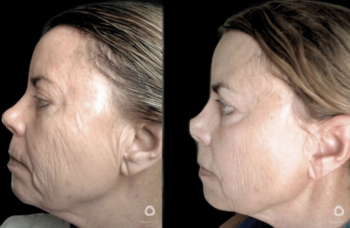 Chemical Peels Before & After Gallery - Patient 314964 - Image 1