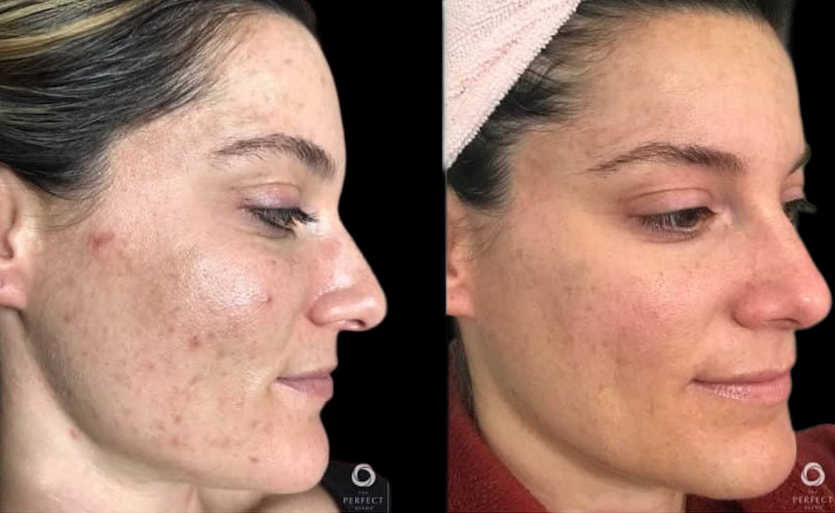 Chemical Peels Before & After Gallery - Patient 256849 - Image 1