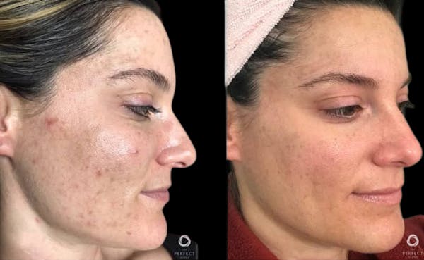 Chemical Peels Before & After Gallery - Patient 256849 - Image 1