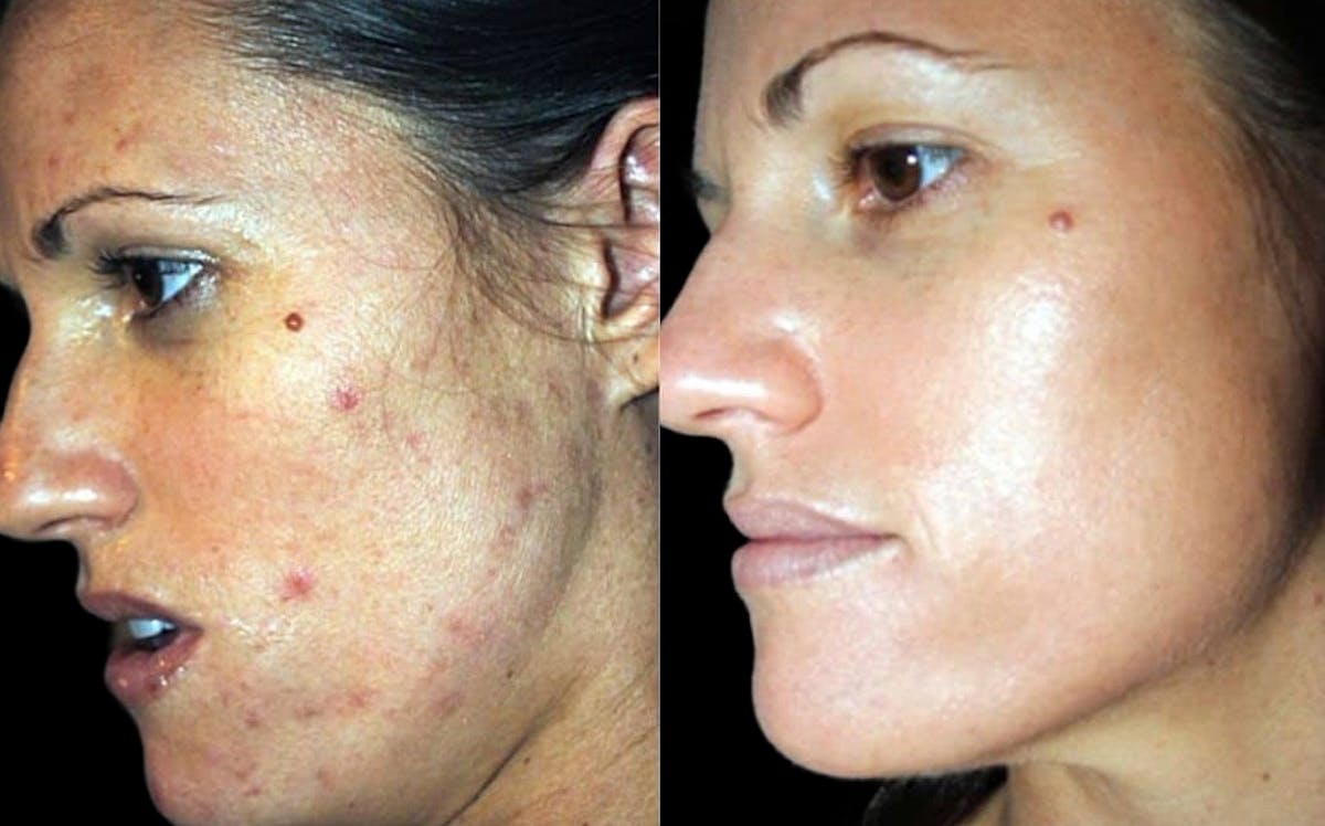 Chemical Peels Before & After Gallery - Patient 194542 - Image 1