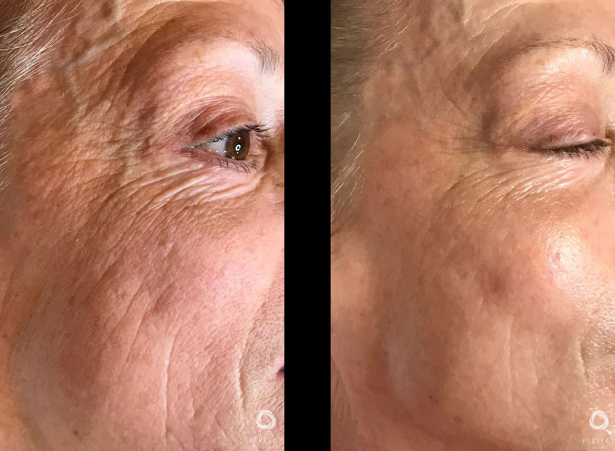Chemical Peels Before & After Gallery - Patient 175917 - Image 1