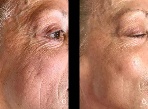 Chemical Peels Before & After Gallery - Patient 175917 - Image 1