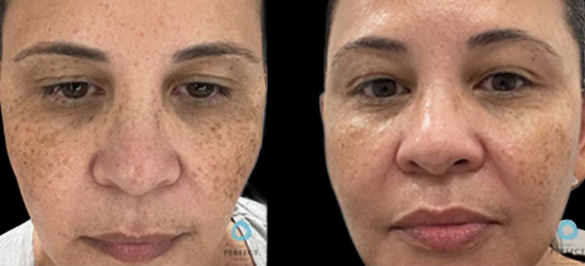 Chemical Peels Before & After Gallery - Patient 341811 - Image 1