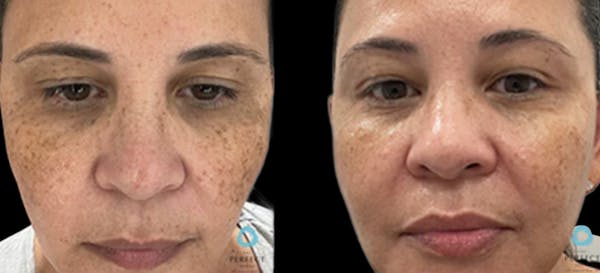 Chemical Peels Before & After Gallery - Patient 341811 - Image 1