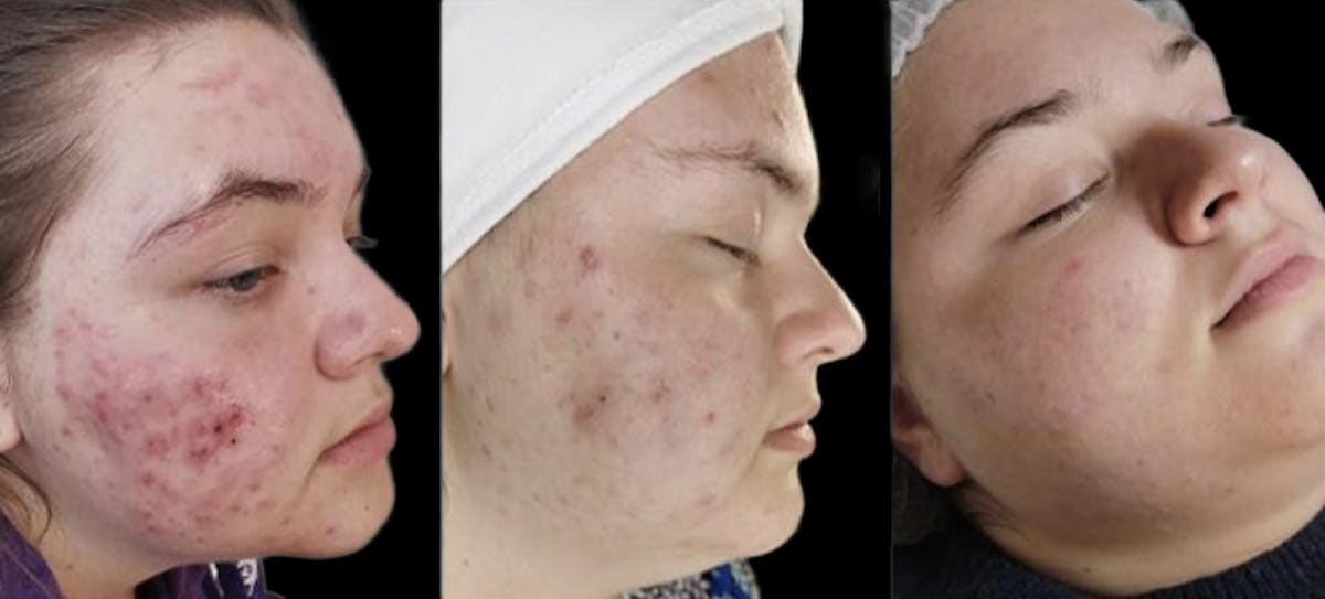 Chemical Peels Before & After Gallery - Patient 423383 - Image 1