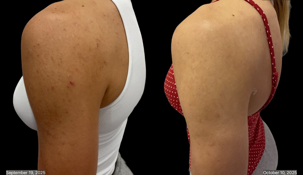 Chemical Peels Before & After Gallery - Patient 424359 - Image 3