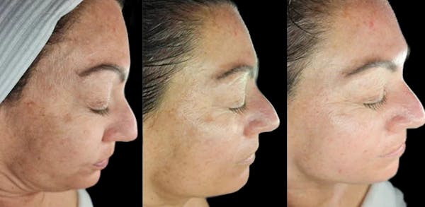 Chemical Peels Before & After Gallery - Patient 329942 - Image 1