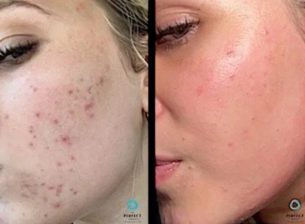 Chemical Peels Before & After Gallery - Patient 252377 - Image 1