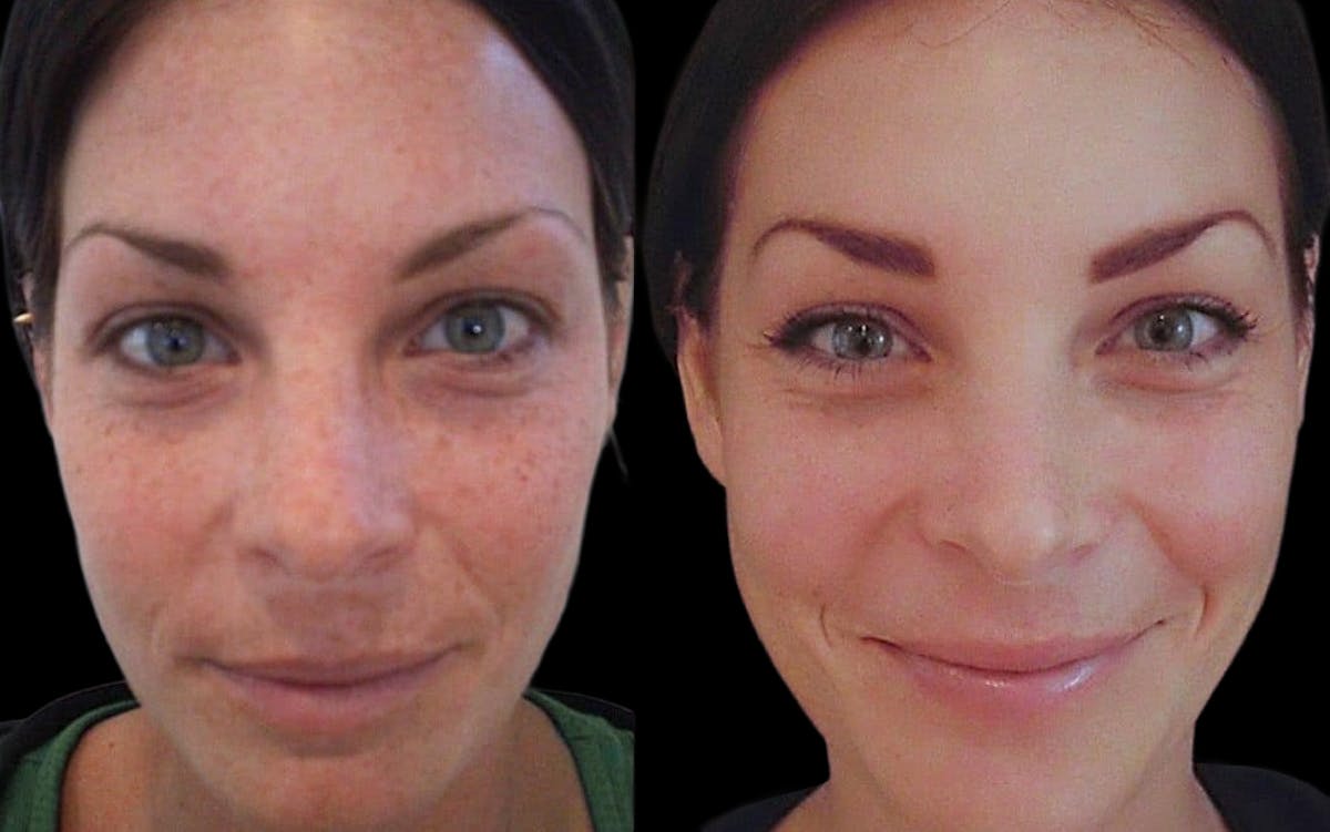 Chemical Peels Before & After Gallery - Patient 409915 - Image 1