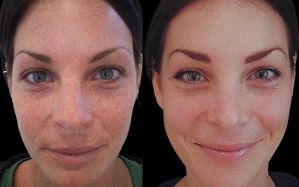 Chemical Peels Before & After Gallery - Patient 409915 - Image 1