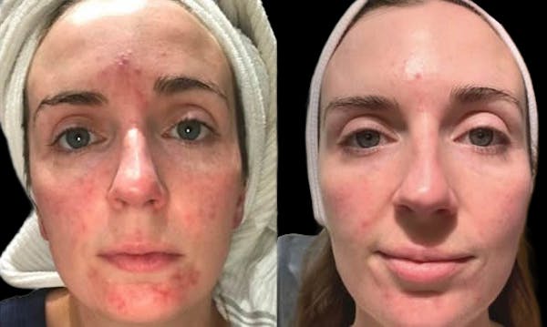 Chemical Peels Before & After Gallery - Patient 111233 - Image 1