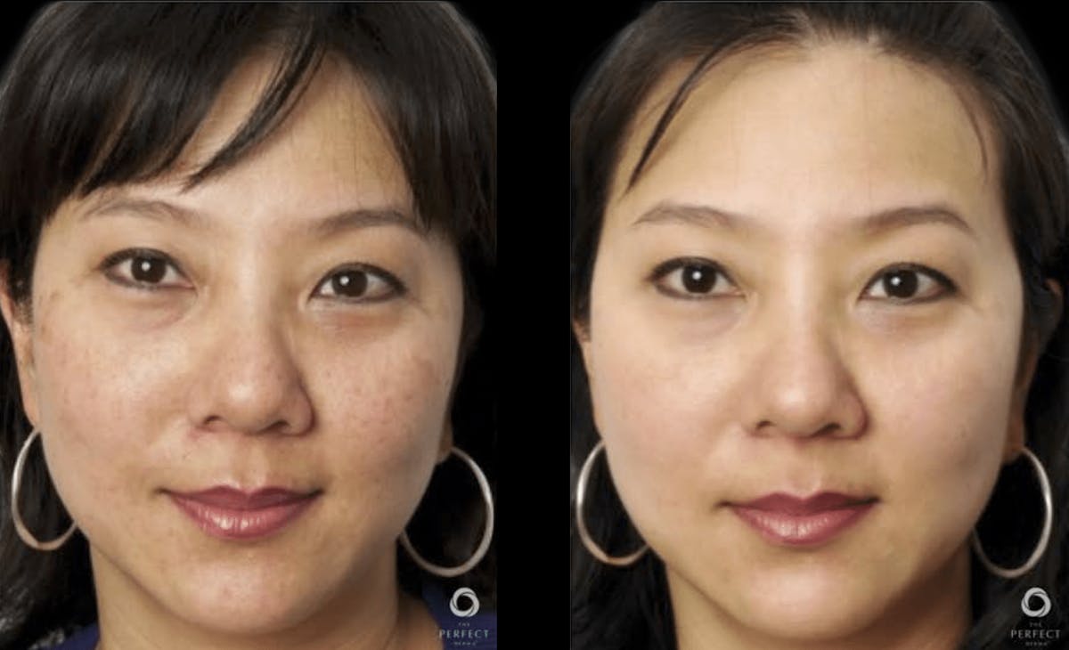 Chemical Peels Before & After Gallery - Patient 392869 - Image 1