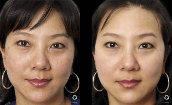 Chemical Peels Before & After Gallery - Patient 392869 - Image 1