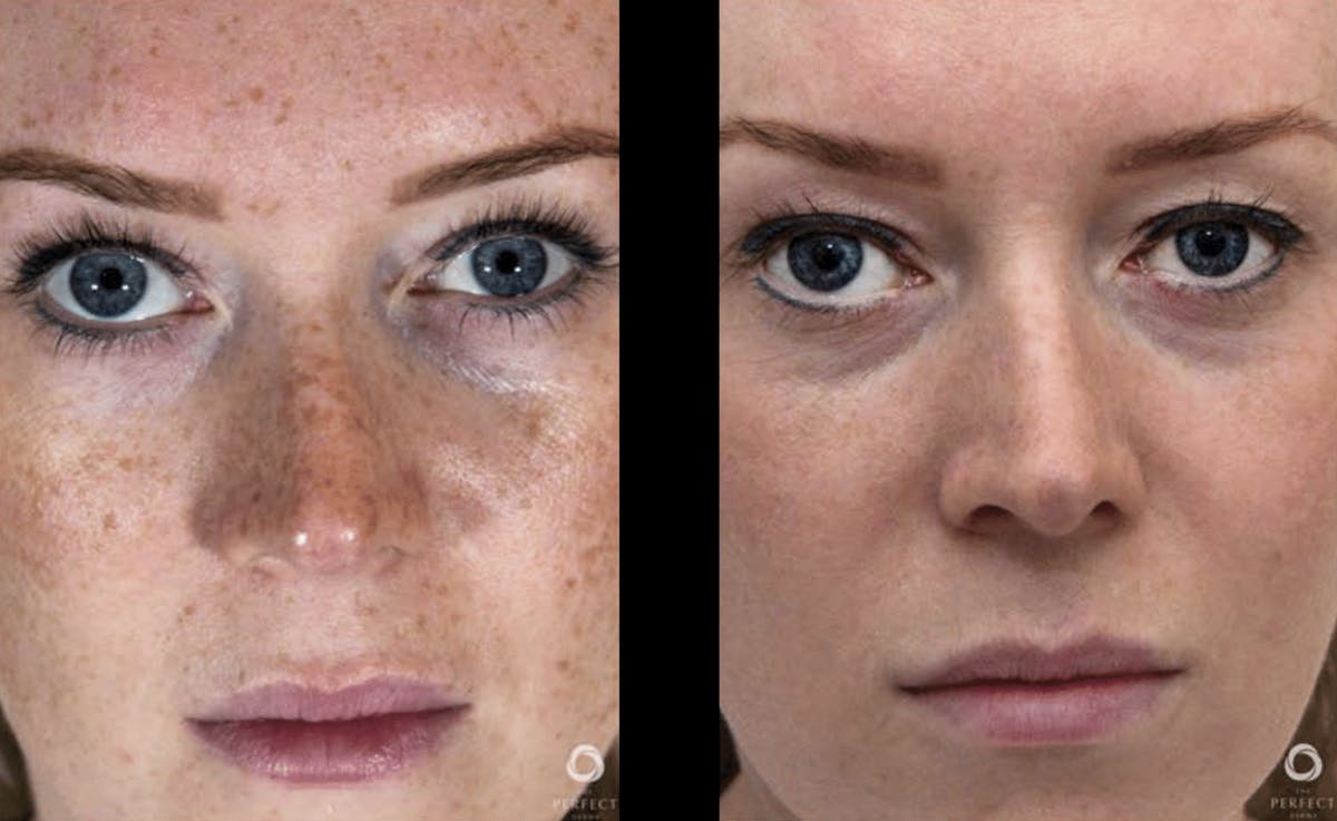 Chemical Peels Before & After Gallery - Patient 311226 - Image 1