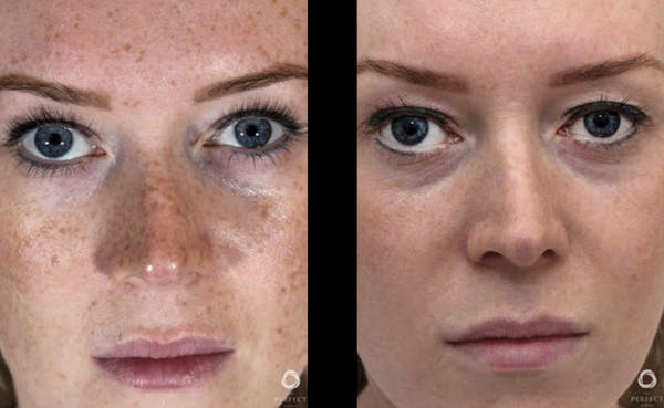 Chemical Peels Before & After Gallery - Patient 311226 - Image 1