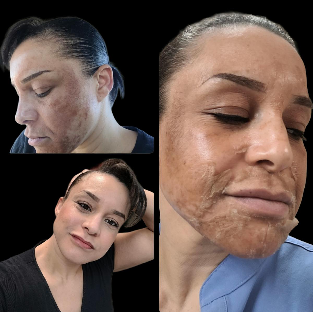Chemical Peels Before & After Gallery - Patient 227856 - Image 1