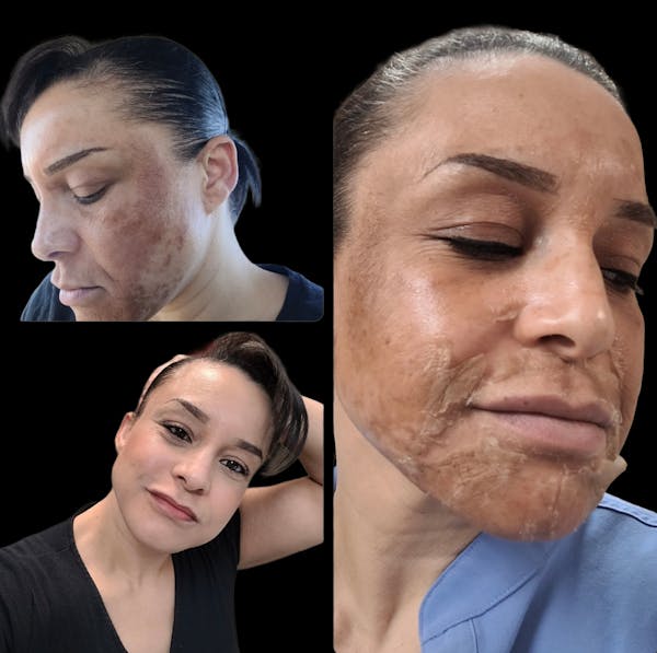 Chemical Peels Before & After Gallery - Patient 227856 - Image 1