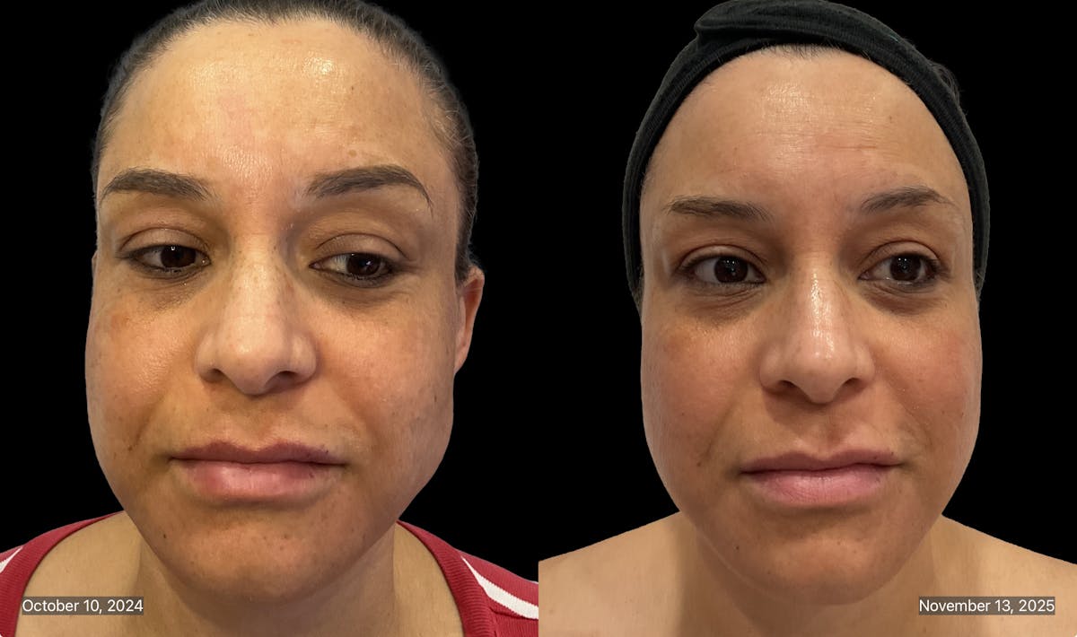 Chemical Peels Before & After Gallery - Patient 227856 - Image 2