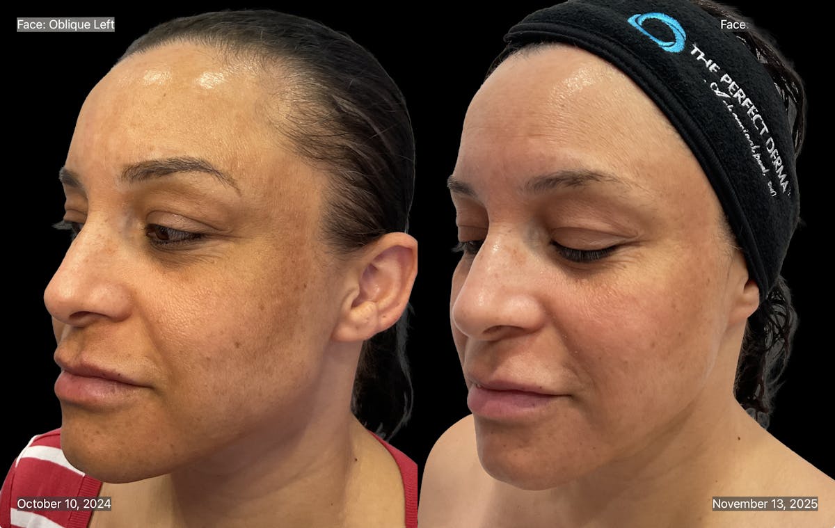 Chemical Peels Before & After Gallery - Patient 227856 - Image 3