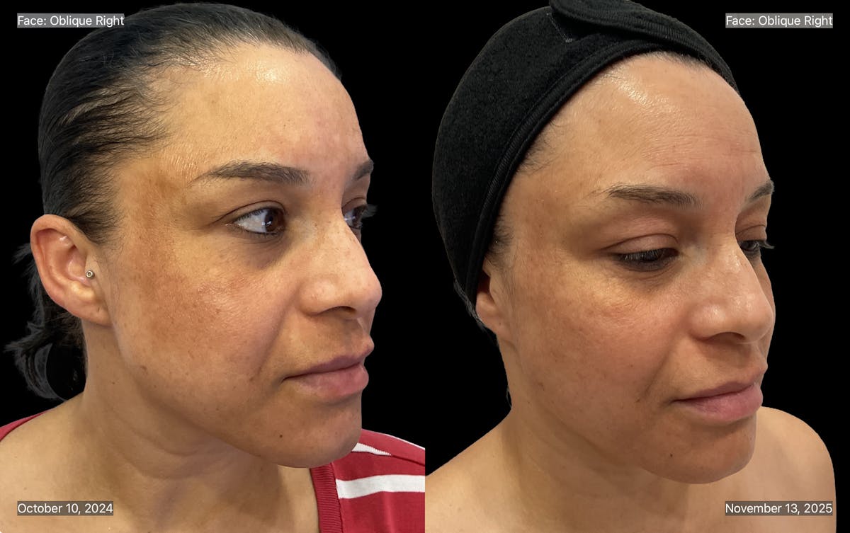 Chemical Peels Before & After Gallery - Patient 227856 - Image 4