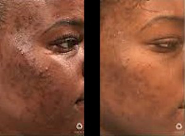 Chemical Peels Before & After Gallery - Patient 273599 - Image 1