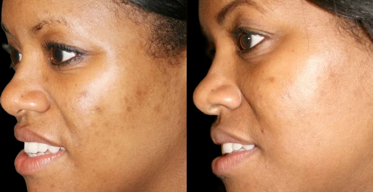 Chemical Peels Before & After Gallery - Patient 675333 - Image 1