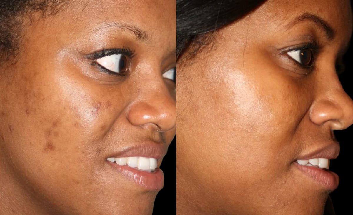 Chemical Peels Before & After Gallery - Patient 675333 - Image 2